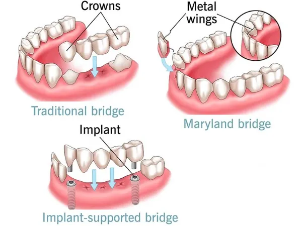 Crown and Bridges